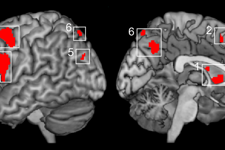 Risonanza magnetica funzionale (fMRI)
